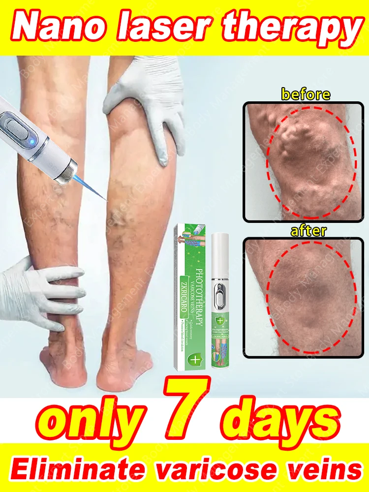 Varicose Veins Products