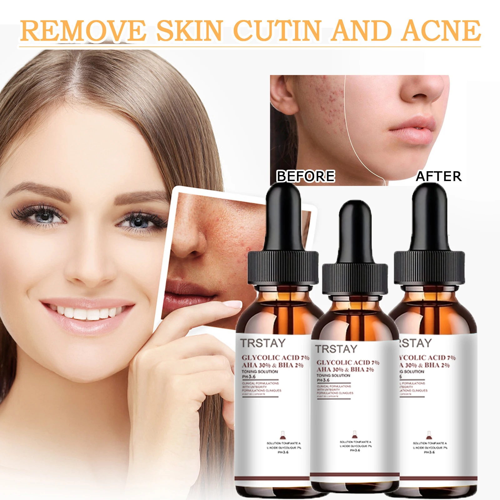 5ML/15ML/30ML/50ML/ GLYCOLIC ACID REMOVE SKIN CUTIN AND ACNE