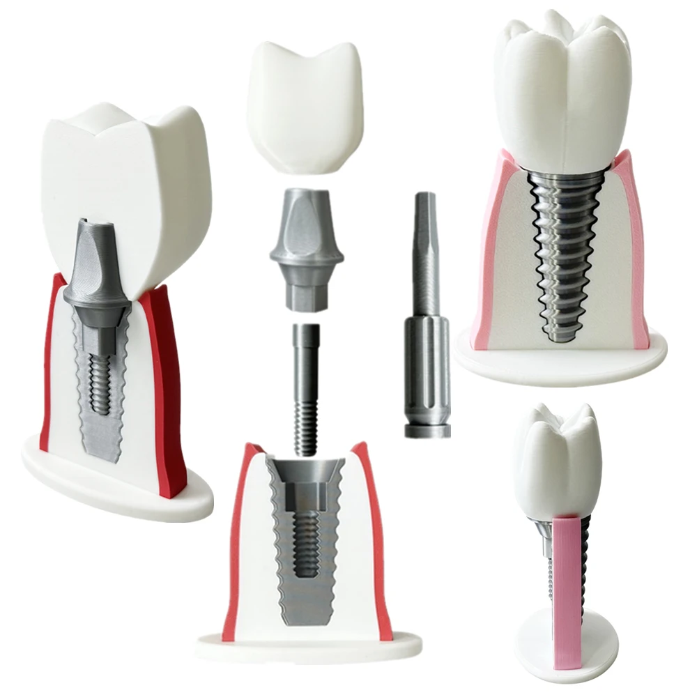 Large Dental Implant Model Practice Teeth Teaching Training Model Detachable Implant Dentist-Patient Communication Demo Model