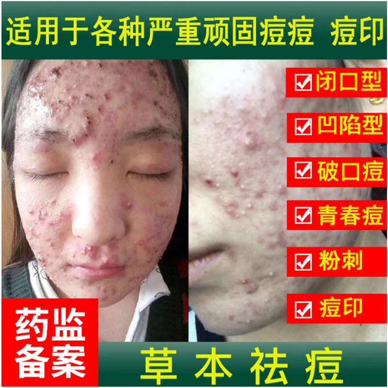 DSM Acne Cream for Teen Pimples & Comedones Men & Women Students Fades Acne Marks & Scars Improves Acne Pit