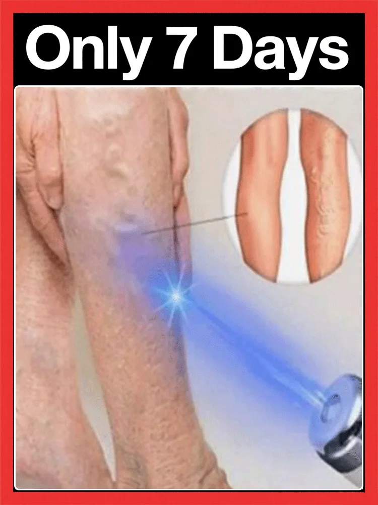 

blue light pen solve varicose veins,2025 NEW hot sale leg care tools