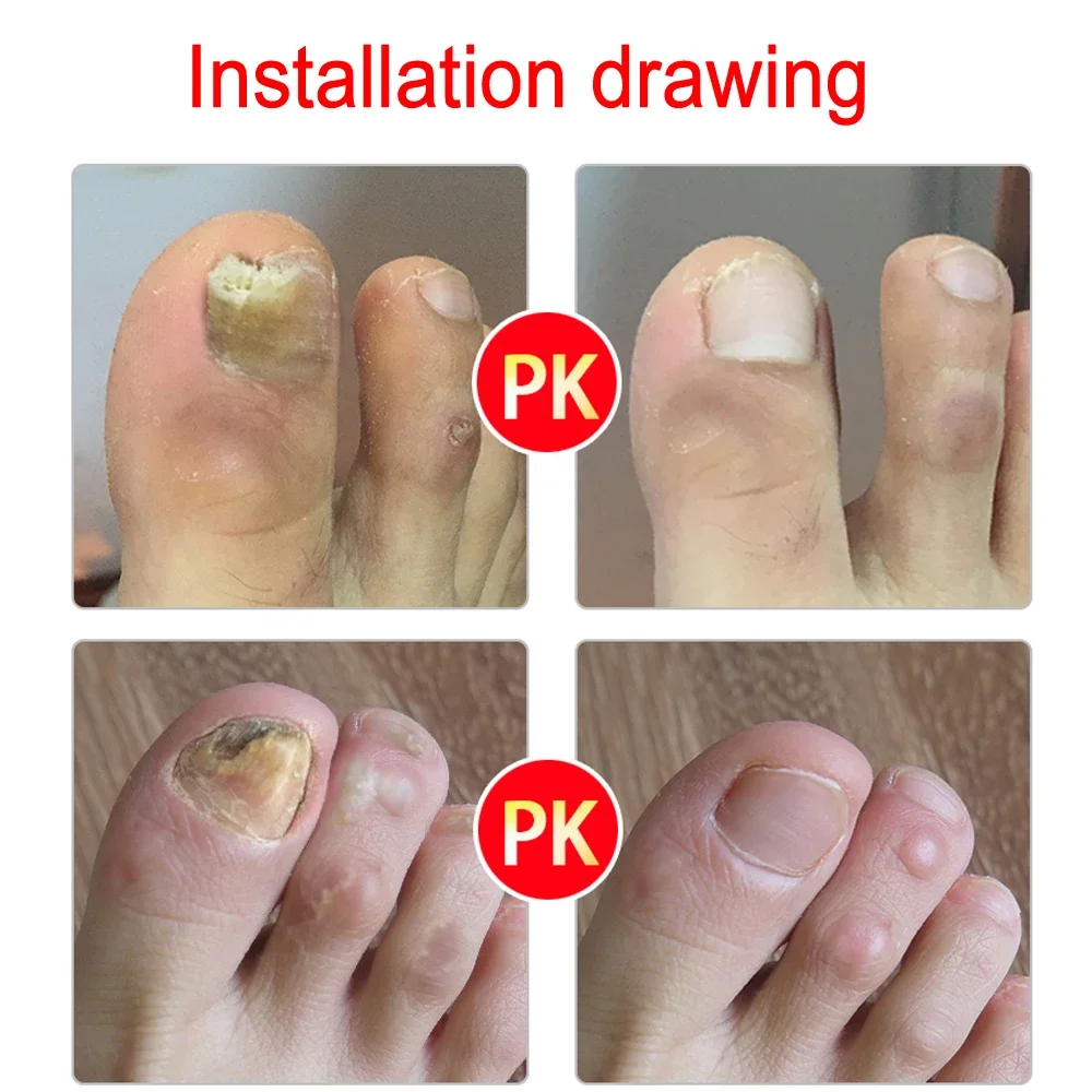 Anti Infection Fungal Nail Treatment Liquid Foot Care Essence Whitening Toe Nail Fungus Removal Gel Paronychia Onychomycosis