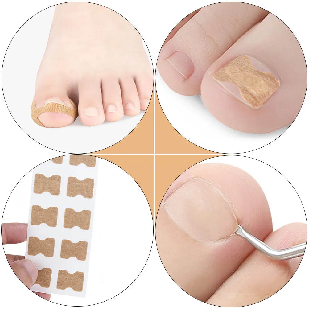 

Pedicure Tools Toenail Correction Buckles Invisible Ingrown Nail Repair Kit Dead Skin Cone Stainless Non-woven