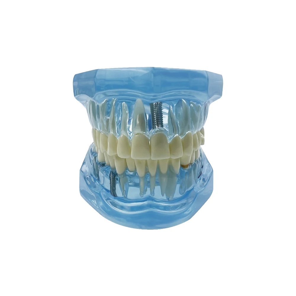 Dental Models Removable And Restorable Models Of Diseased Teeth For Teaching Dental Typodont Model With Removable Teeth Bridge