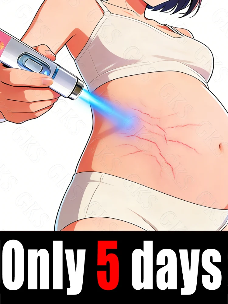 

Синяя светотерапия уменьшает растяжки и помогает вам попрощаться с ними.