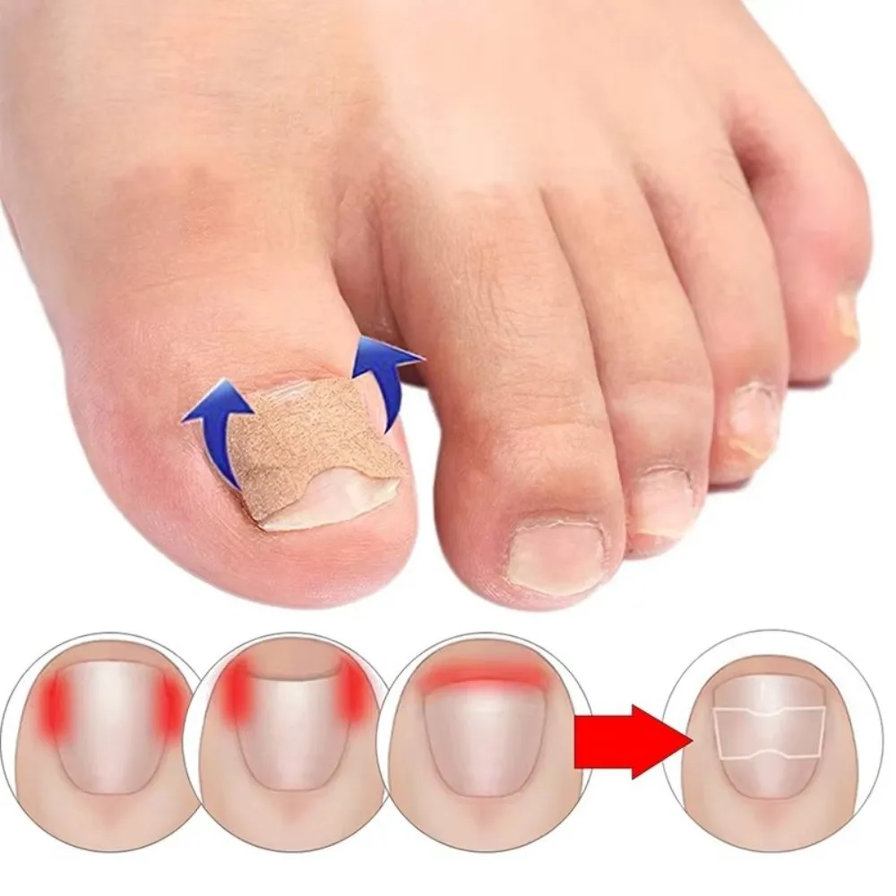 100Pcs Adhesive Ingrown Toenail Correction Stickers Elastic Nonwoven Flexible Toenail Shaping Strips Breathable