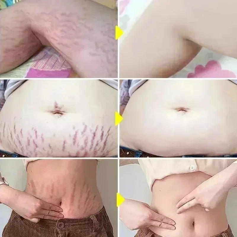Stretch Marks Permanent Remova - Skincare Oat ulasan dan harga