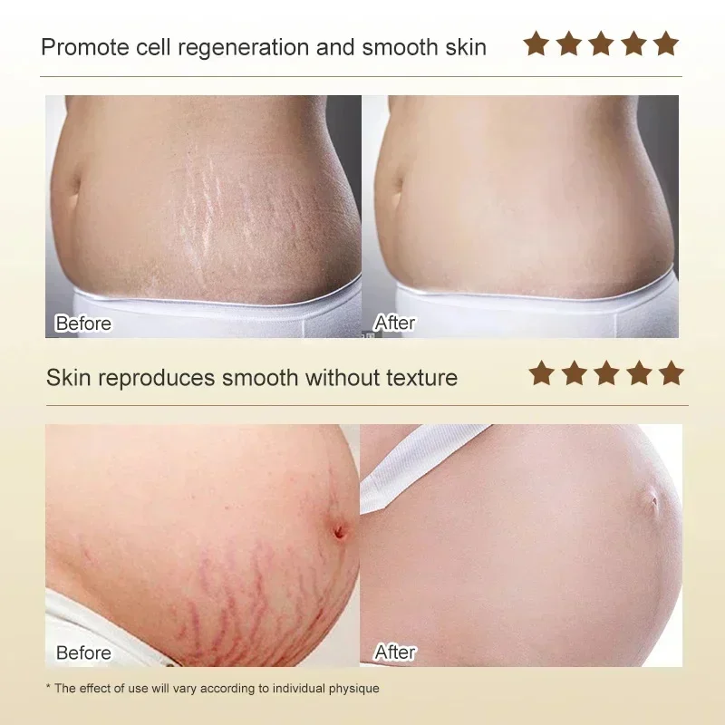 Krim penghilang Stretch mark, krim penghilang permanen menghilangkan Stretch mark perut Tubuh tanda bengkak menghilangkan kulit pecah-pecah Perawatan Pengencang