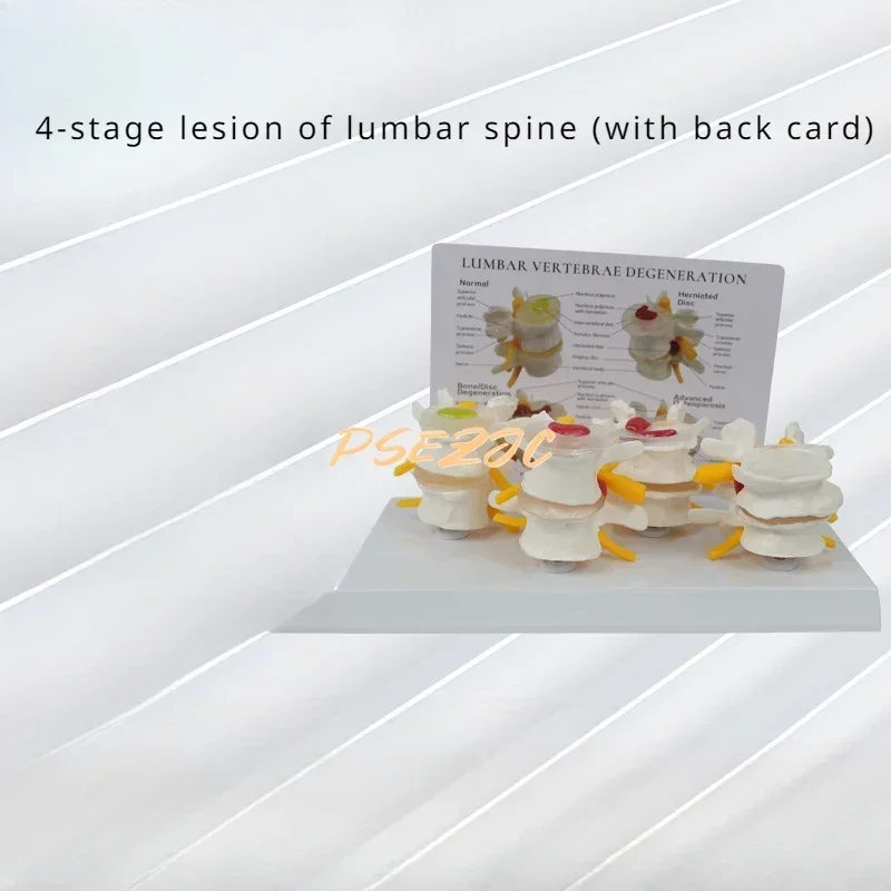 Stage 4 Pathology Lumbar Spine Human Model Orthopedic Teaching Demonstration Assisted Demonstration Teaching (with Back Card)