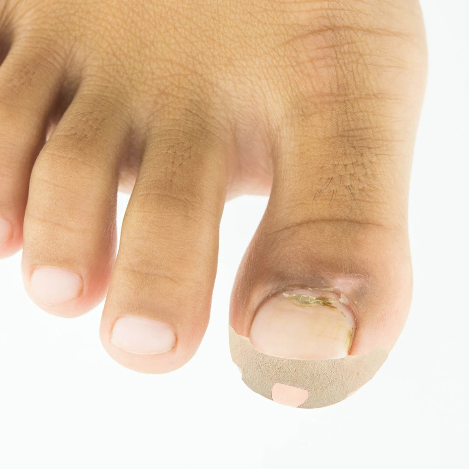 

12pcs Toenail Correction Patch Ingrown Nail Relief Bunion Protection No Glue Curved Toenail Sticker Pedicure Tool