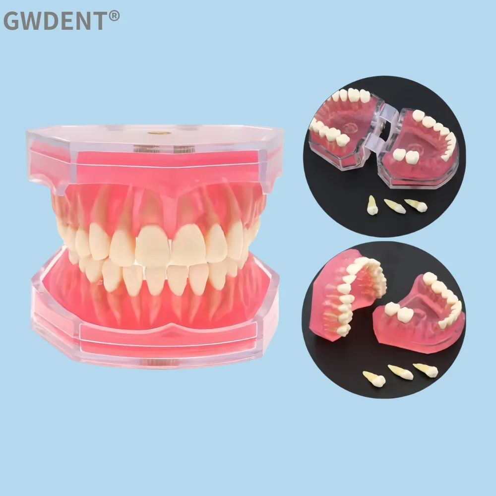 

Dental Teeth Model Implant with Removable Dental Education Model for Dentistry Laboratory Demo Studying Dentistry Products Tool