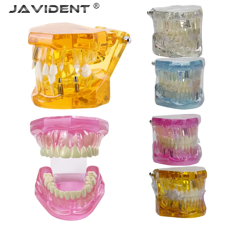 

1 шт. Модели зубных имплантатов, модели для патологии полости рта, комплексные учебные модели для стоматологии, модели реставраций с фиксированными мостами и винирами