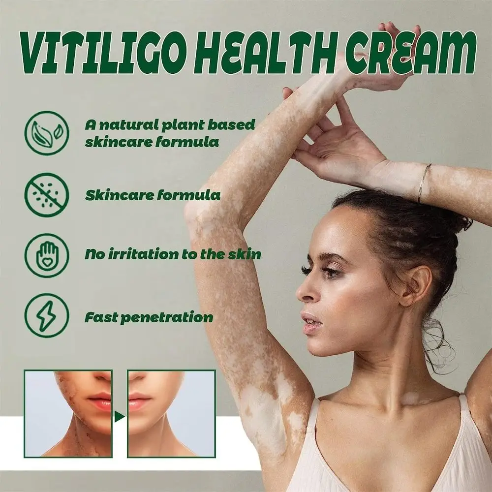 Natuurlijke Treatvitiligo Verzachtende Crème Verbeteren Huidverkleuring Hydrateert Vitiligo Verzorgingscrème Huidverzorging Snel Rustgevend