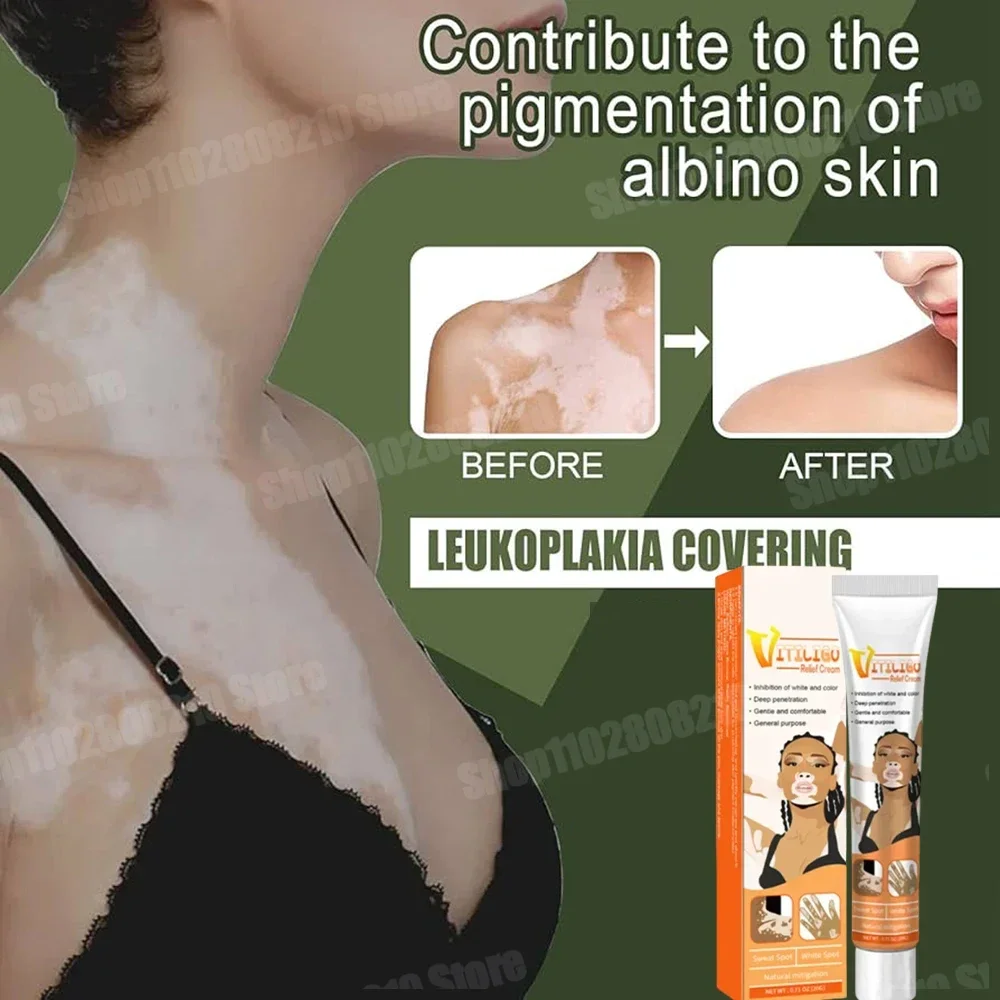 White Spot Removal vitiligo ointment Eliminate pigment Vitiligo cream Vitiligo derma relief Skin soothing