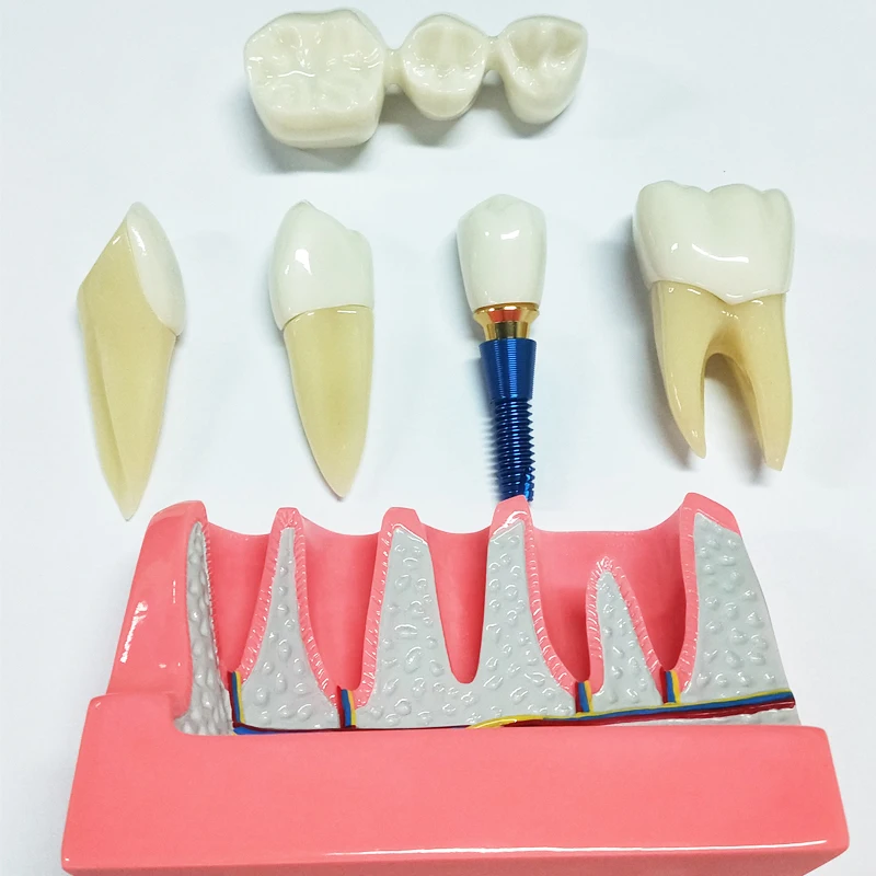 Modèle d'implant dentaire 6/8x, modèle de dent en contraste de caries grossie, modèles d'implant dentaire en couronne pour la Communication du médecin-paient