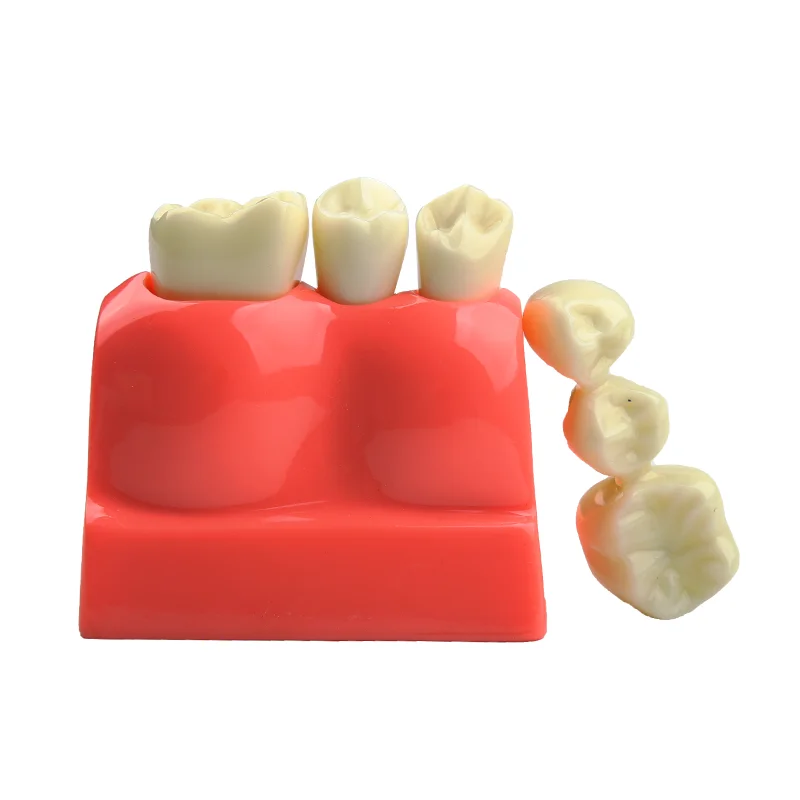 Dental Model Dental Implant Model Denture Bridge Crown Porcelain Restoration Model Dentist Teaching Demonstration Models