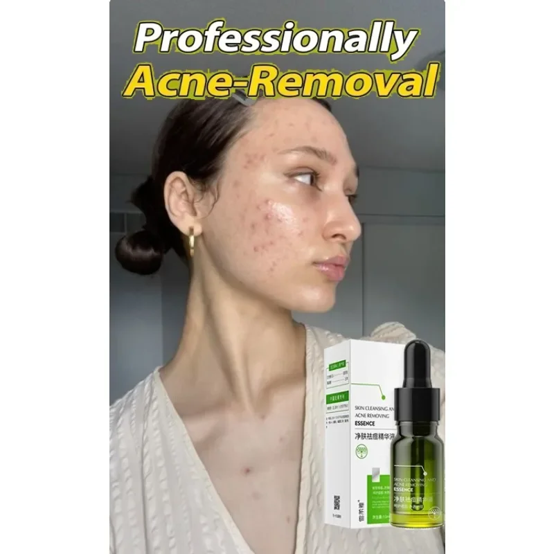 

Effective Acne Removal Comfortable Acne-removing Liquid Improve Acne Convenient Facial Repair Solution Skin Care Products Gentle