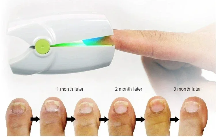 

Nail Fungus Laser Treatment Nail Fungus Remover Anti-Infection Nail Fungus Disease Neutral Tinea Pedis Treatment Device