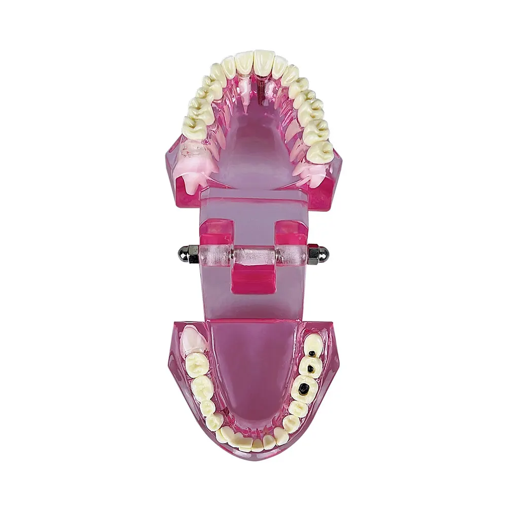 Dental Implant Teeth Repair Model With Restoration Bridge Teaching Study Medical Science Disease Dentist Dentistry Products