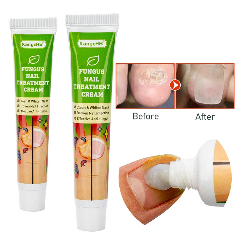 1Pcs Nail Fungal Treatment Ointment Anti Infection Paronychia Onychomycosis Foot Toe Nail Fungus Removal Cream Feet Care G004