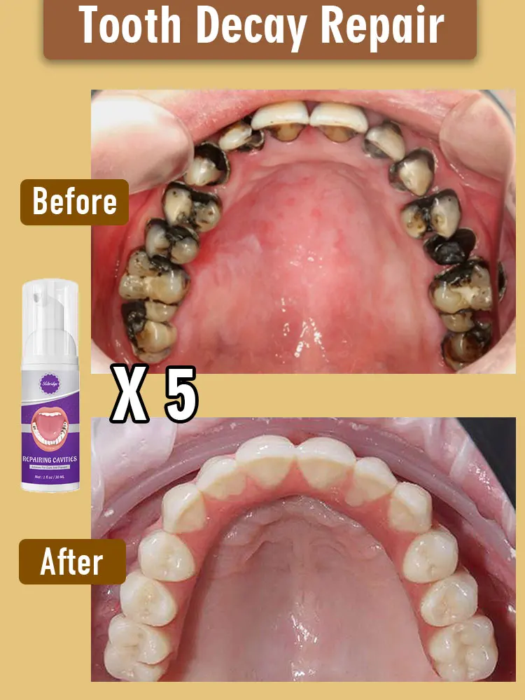 Special fluoride tooth decay repair mousse for babies