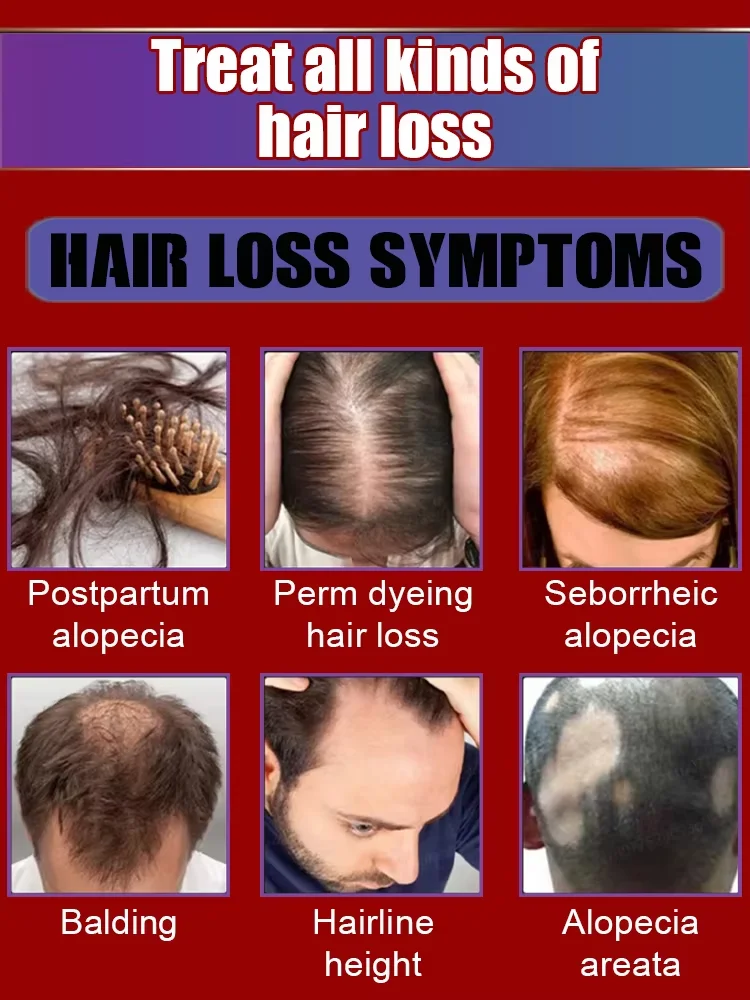 Officiële directe verkoop zorgen voor succesvol gedragen 30w+ mensen ontdoen met haaruitval