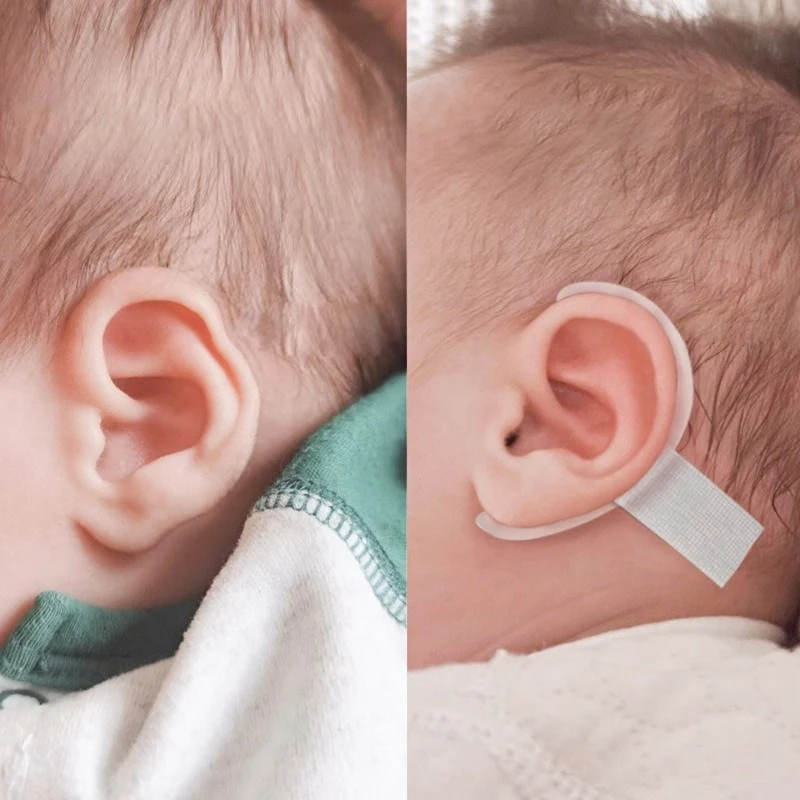 Protruding Ear Support Infant Corrector Tools Silicone Auricle Correction Patch For BabyEar Corrector Baby Auricle Valgus Corre