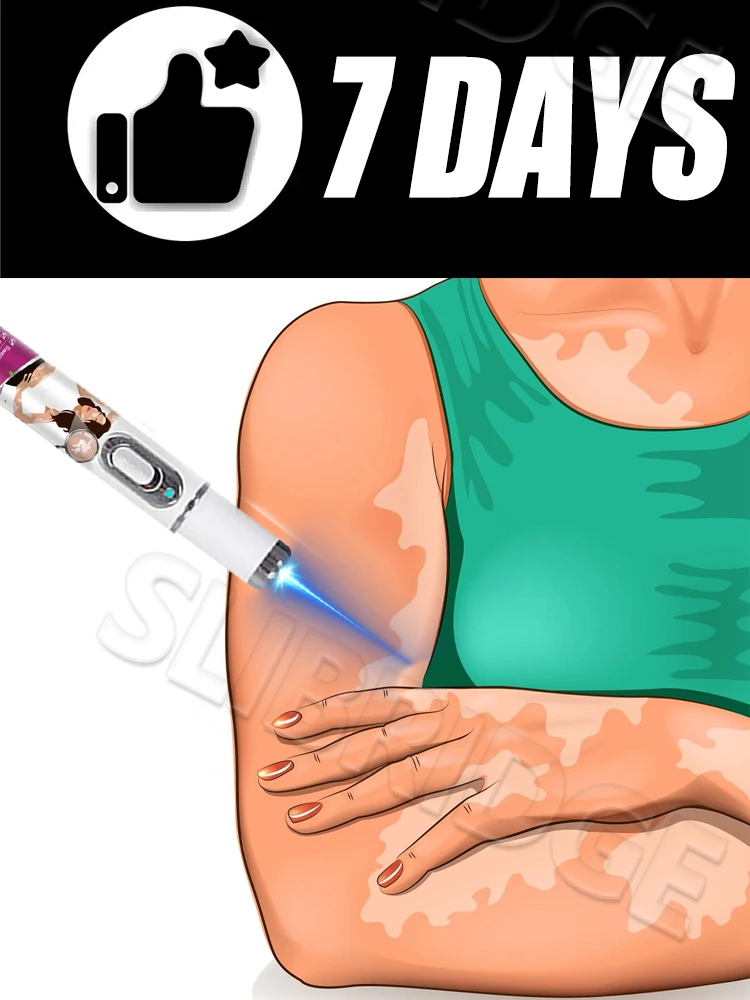 la penna a luce blu risolve il vitiligine, strumenti per la cura del vitiligine, unisex, vendita calda 2025