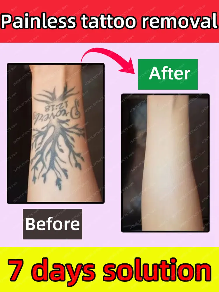 

Fast safe tattoo fading