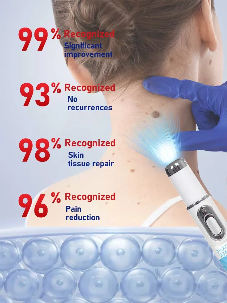 Warts Blue Light Tool  Quick wart removal