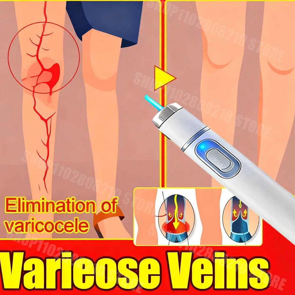 2e generatie laser veneuze behandelpen, gebruikt om spataderen te behandelen223