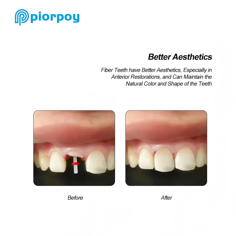 PIORPOY مجموعة المشاركات الألياف للأسنان ألياف الأسنان كومة الموضوع الألياف آخر 1.0/1.2/1.4/1.6 مللي متر 20 المشاركات + 4 تدريبات قناة الجذر لطب الأسنان #6