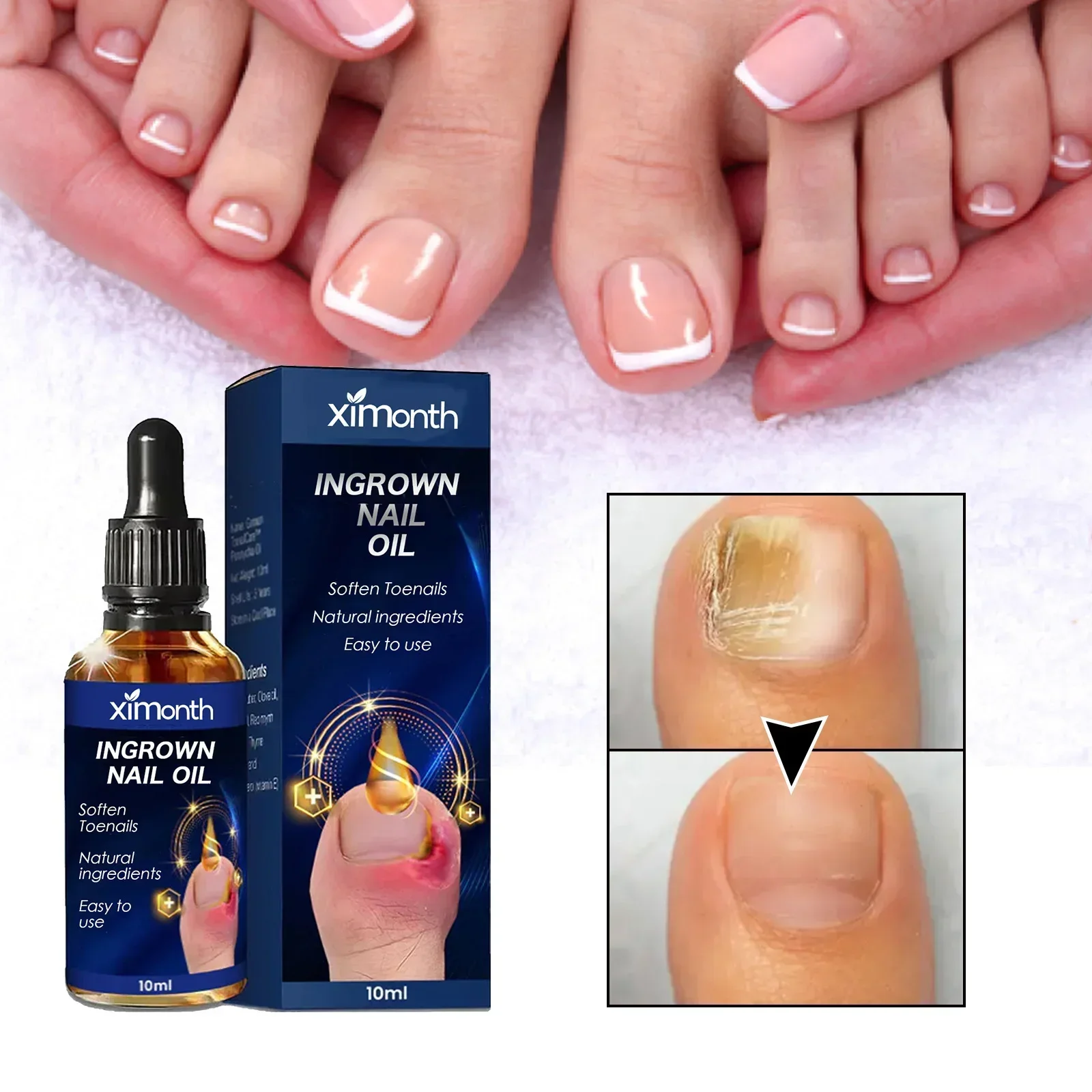 

Nail Fungals Renewal Nail Repair Liquid for Discolored Thickened Crumbled Nails Nail Fungals for Discolored Broken Cracked SF700