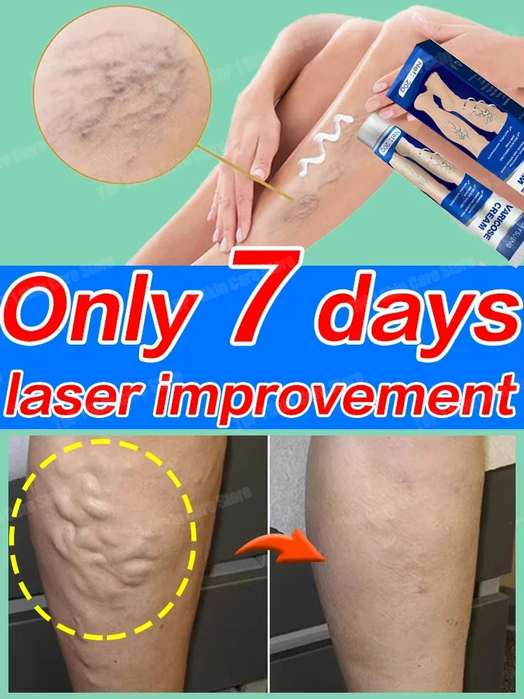 Improve Blood Circulation Varicose Veins Treatment Cream Fast-Acting Reduce Leg Swelling Wellness Cream Soothes Tired