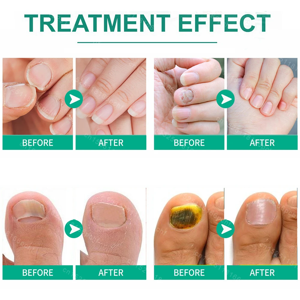 Óleo essencial para tratamento de unhas fúngicas, resolve problemas de fungos nas unhas dentro de 7 dias