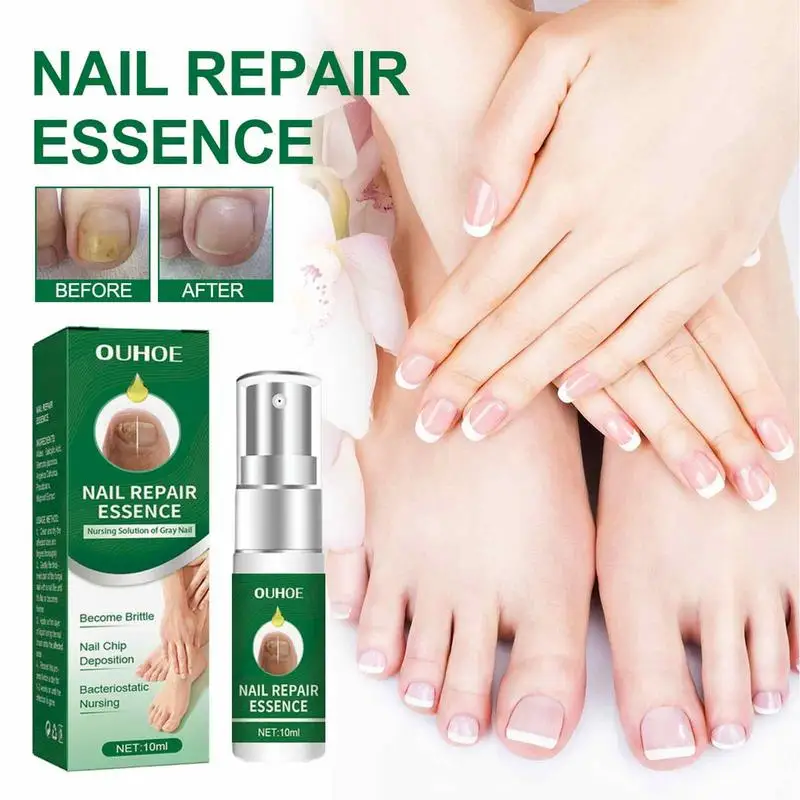 Essência do reparo do prego para o cuidado do toenail, solução para reparar o molde danificado, quebrado rachado, soro descolorido das unhas, essência natural, correção