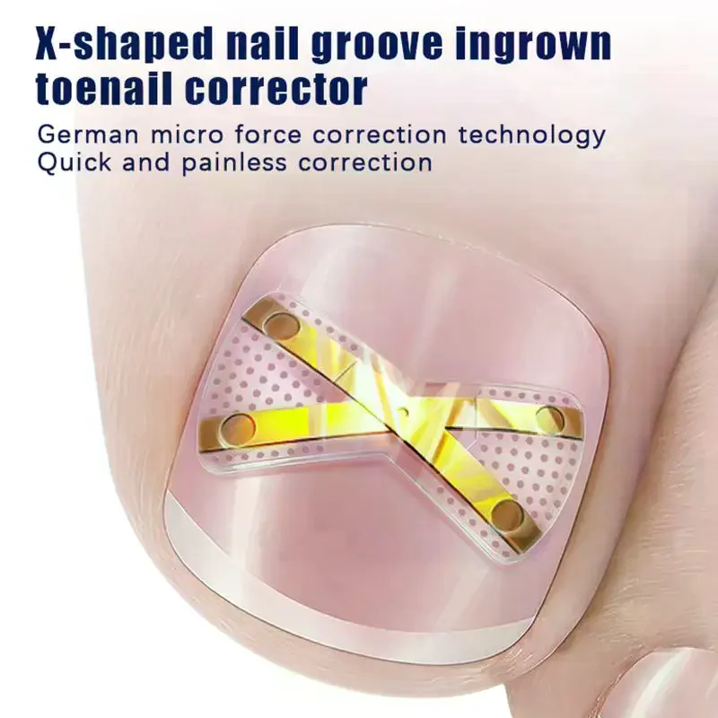 X-shaped Ingrown Toenail Correction Tool Ingrown Toenail Treatments Elastic Patch Sticker Toenail Straightening Pedicure Tool