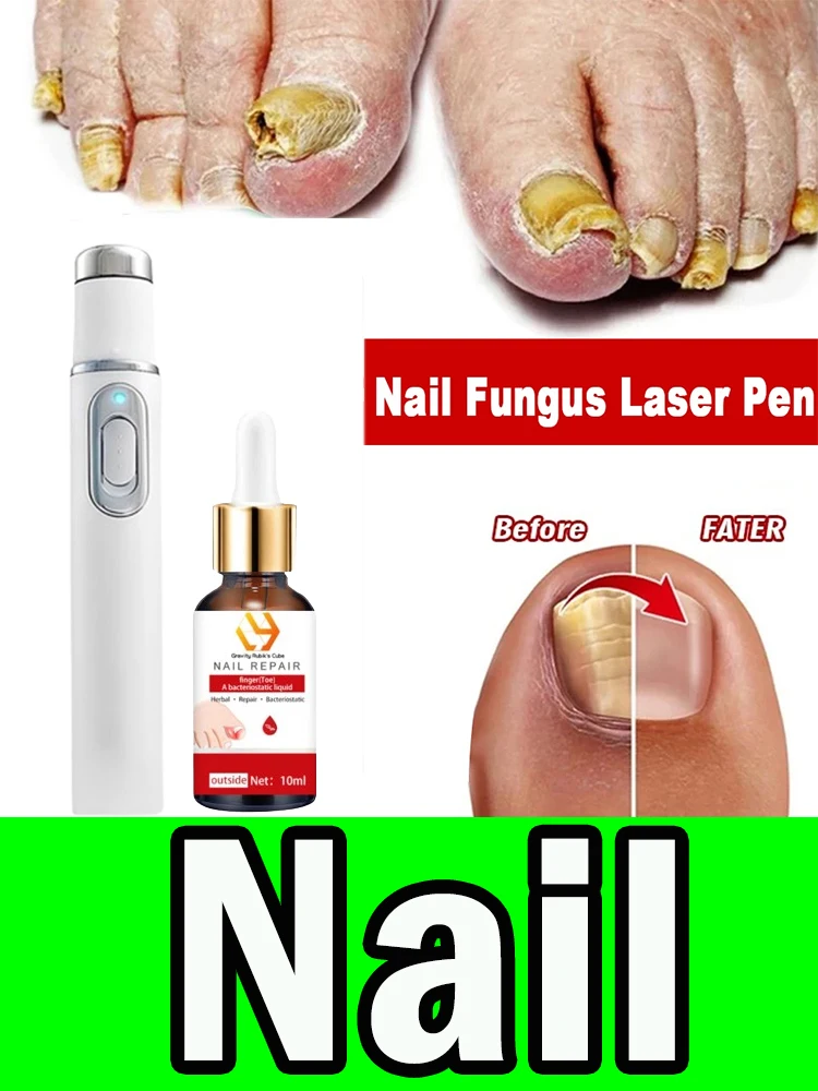 Repair Quickly Nails Laser Fungus Onychomycosis