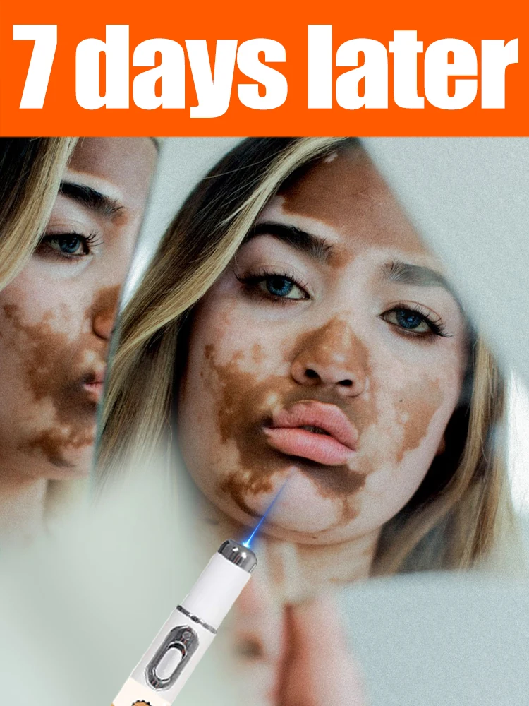 

Vein blue light tool Combination Set Package Tools Can Says Goodbye To Vitiligo