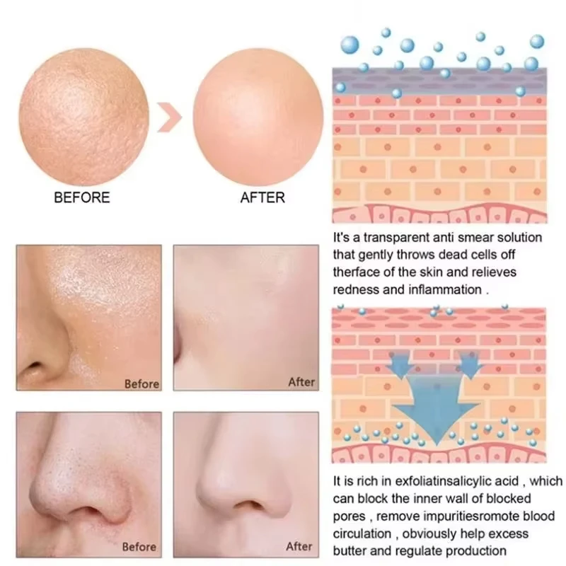 سيروم إزالة المسام الكبيرة، حمض اللاكتيك، منتجات إصلاح تقليص مسام الوجه، تقليل المسام، ثبات العناية بالبشرة الكورية الناعمة.