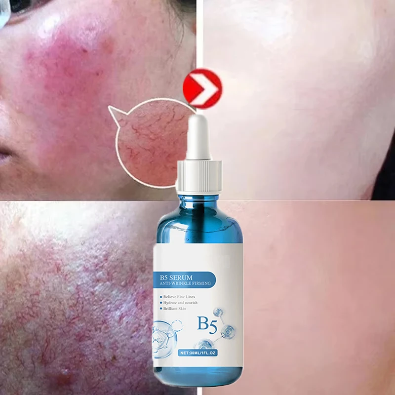 Repair Facial Redness Serum Instant Spider Vein Remove Sooth Sensitive Skin Anti Redness Rosacea Treat Lotion Korean Cosmetics