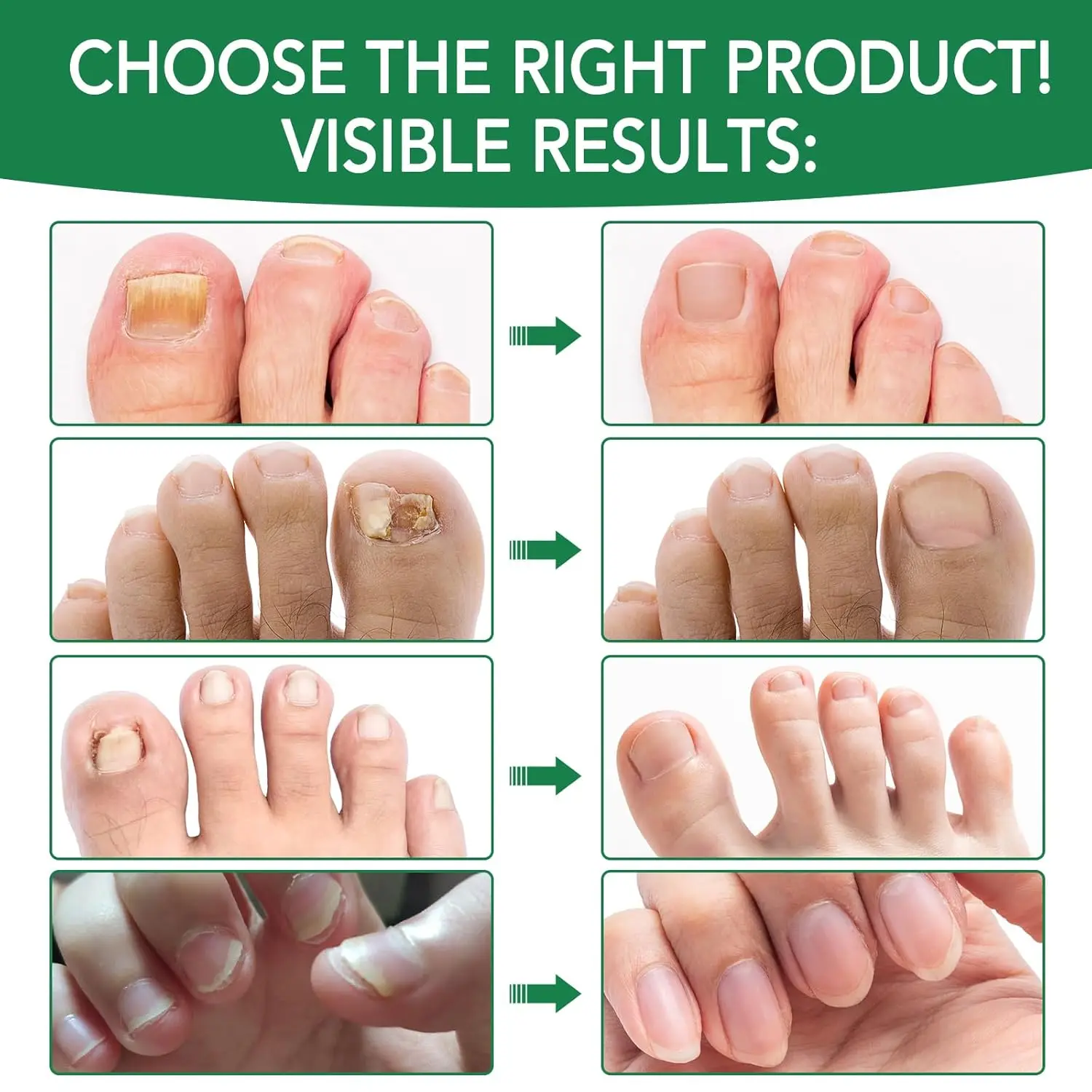 سائل تعقيم فطريات الأظافر 30 مل - العناية بالأظافر فطار الأظافر يساعد على تحسين متشقق متغير اللون لأظافر القدم والأظافر