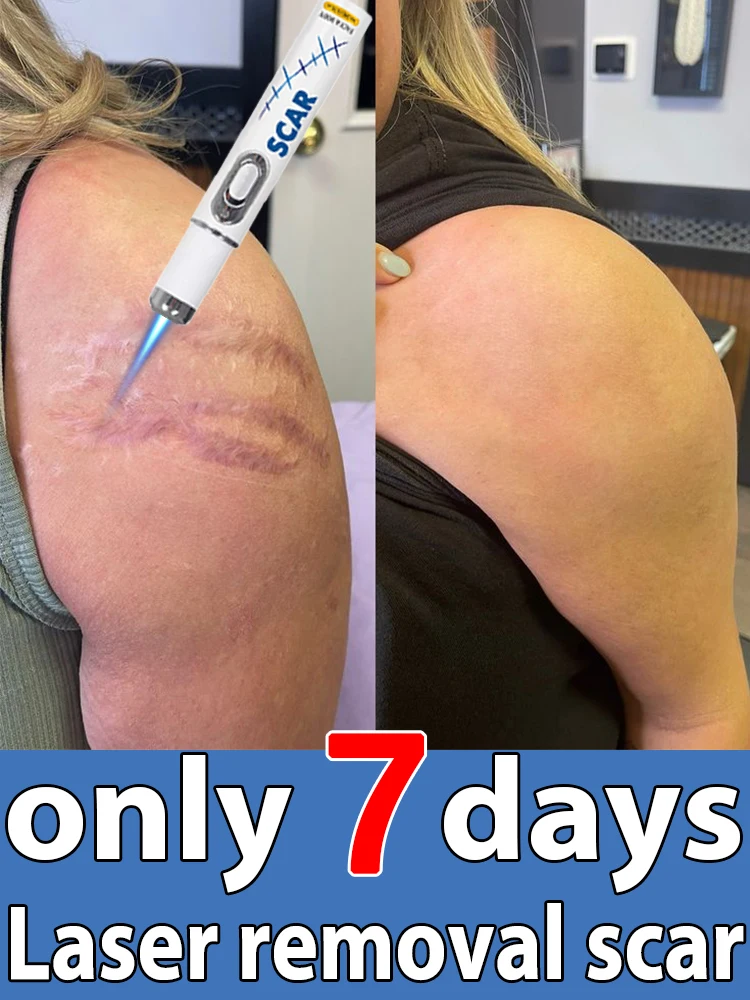 

The latest scar removal technology, remove scars in 7 days, best-selling product in Asia