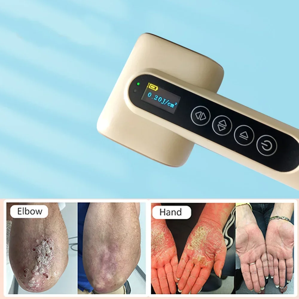 

Устройство для светотерапии UVB 2026, УФ-фототерапия для лечения витилиго, псориаза, физиотерапевтическое оборудование для людей или животных