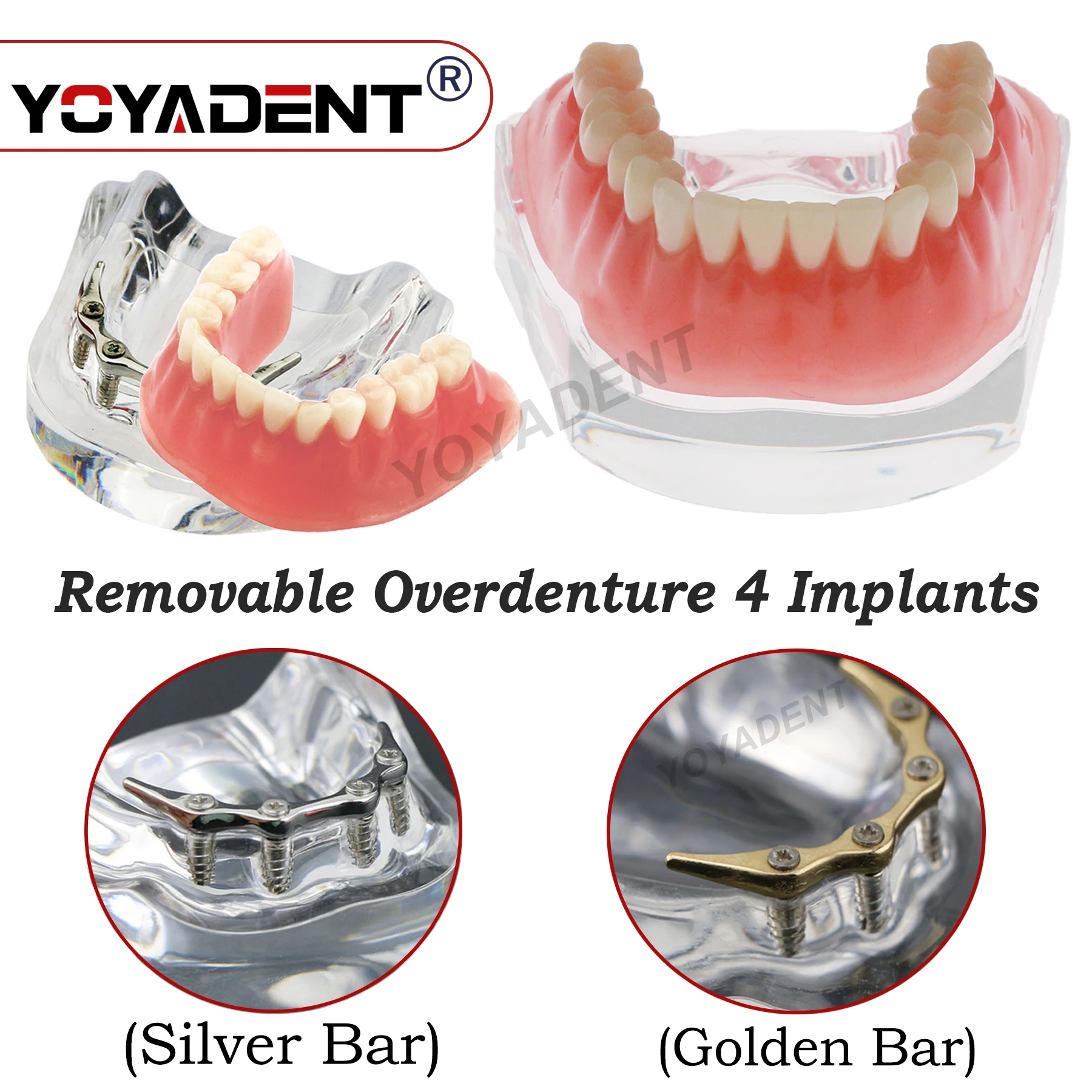 

Dental Implant Teeth Model Removable Overdenture with 4 Implants For Dentist Communication And Patient Teaching