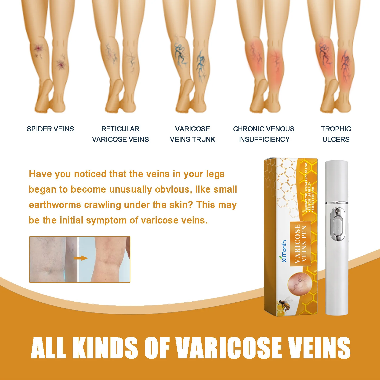 Powerful Laser Therapy Improves Moderate Varicose Veins, Relieves Pain and Improves Circulation In Men and Women