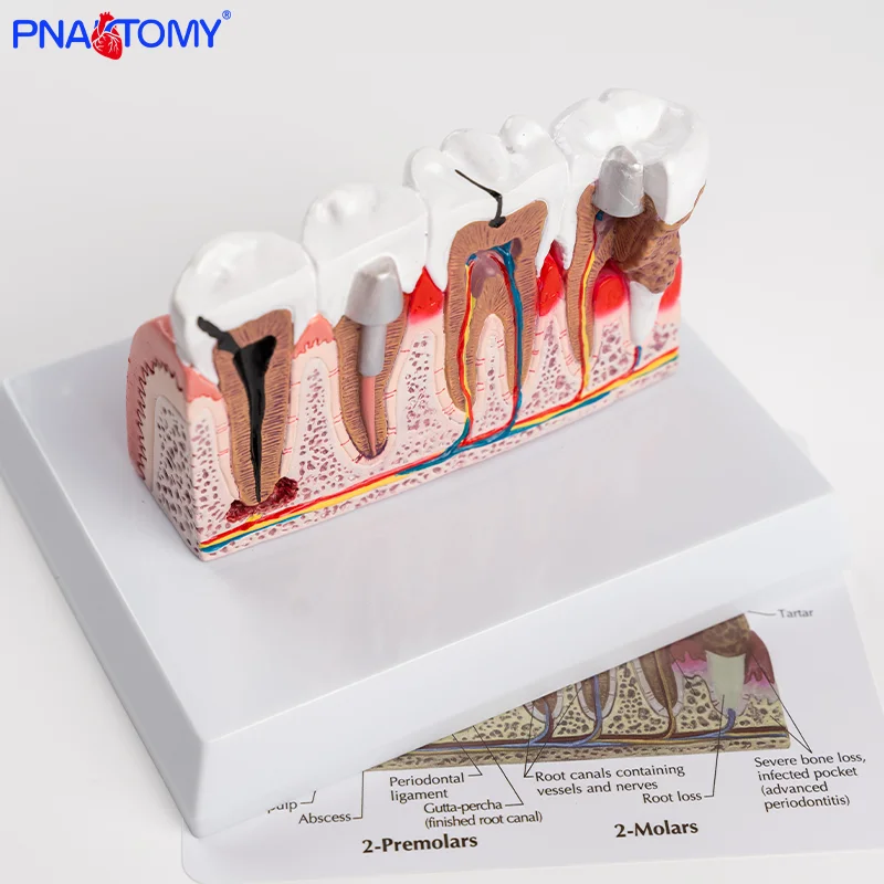 

Pathological Tooth Model for Adults Pathological Dental Model Oral Model Dental Teaching Model