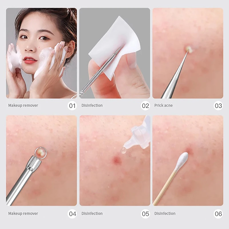 검은 점 여드름 블랙헤드 리무버 도구 바늘, 짜기 여드름 도구 스푼, 얼굴 청소 코메돈 추출기 모공 클리너