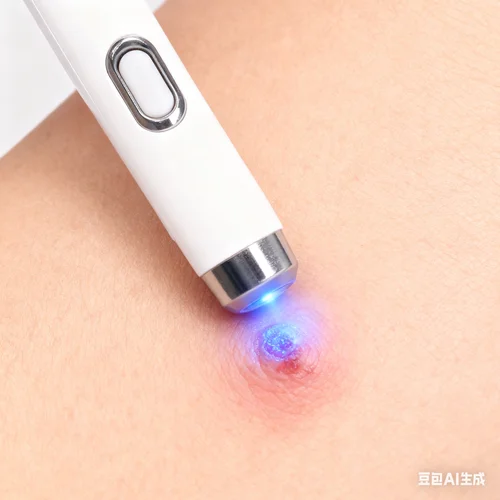 Verrugas mejoradas de segunda generación reparación de raíz de verrugas uickly 8