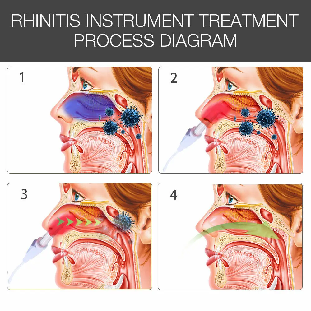 810nm GaAlAs Laser Therapy for Rhinitis Sinusitis with Red Light Nasal Treatment 20MW Output Tempered Glass Lens Portable Design
